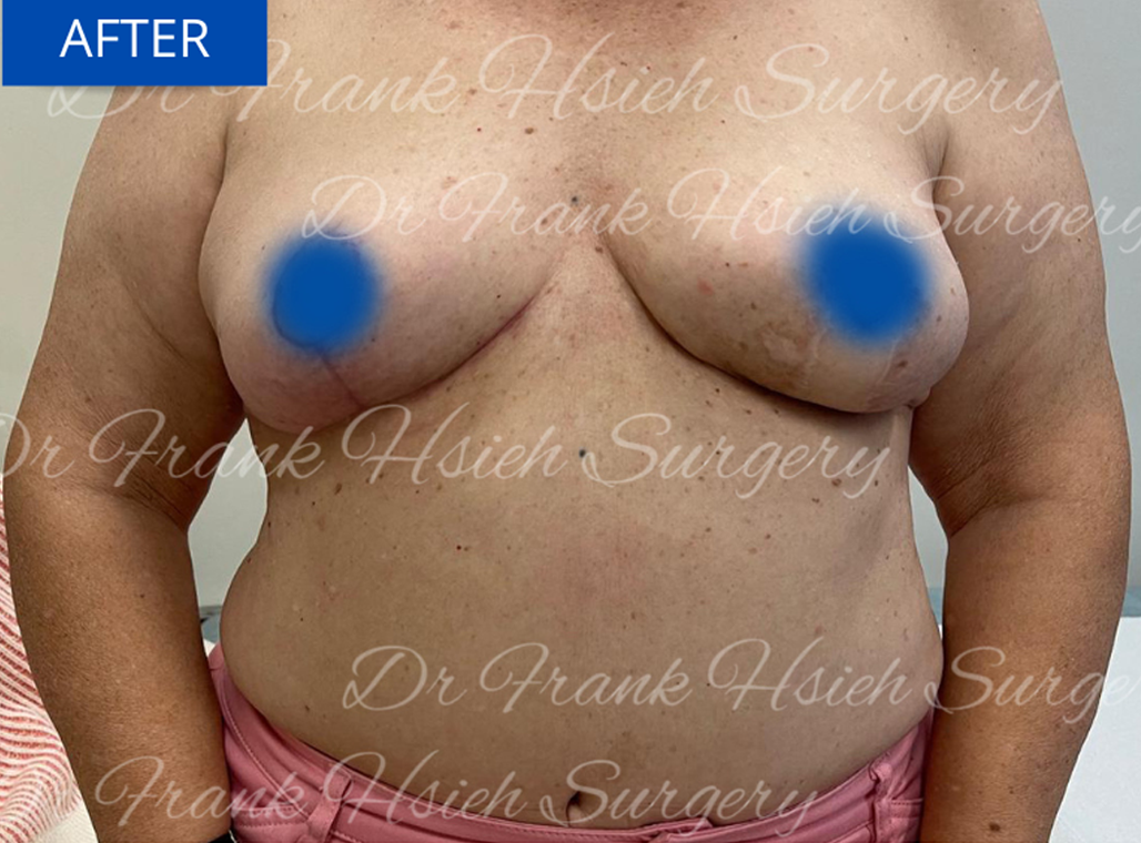 breast reconstruction on 65 year old woman - after