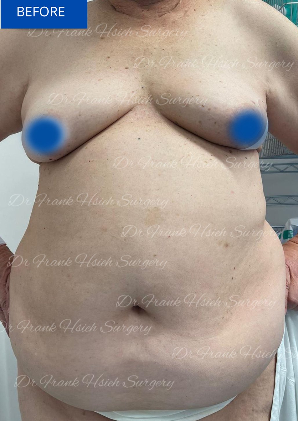 breast reconstruction on 65 year old woman - before
