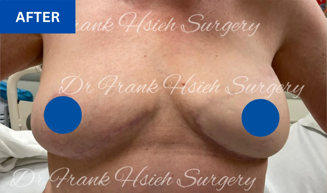 breast reconstruction after