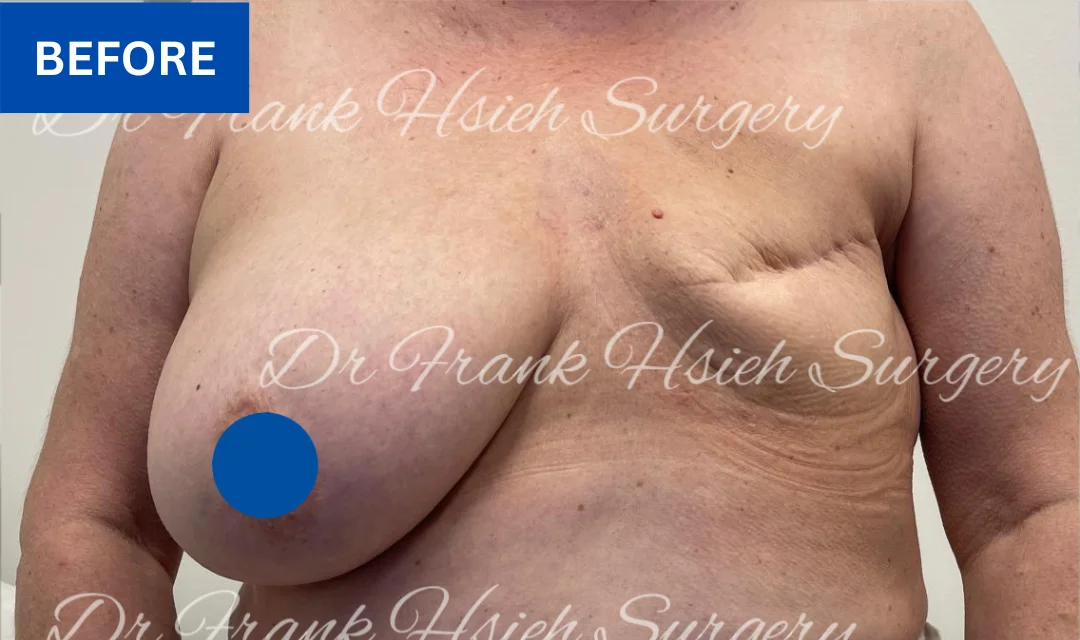 breast reconstruction before