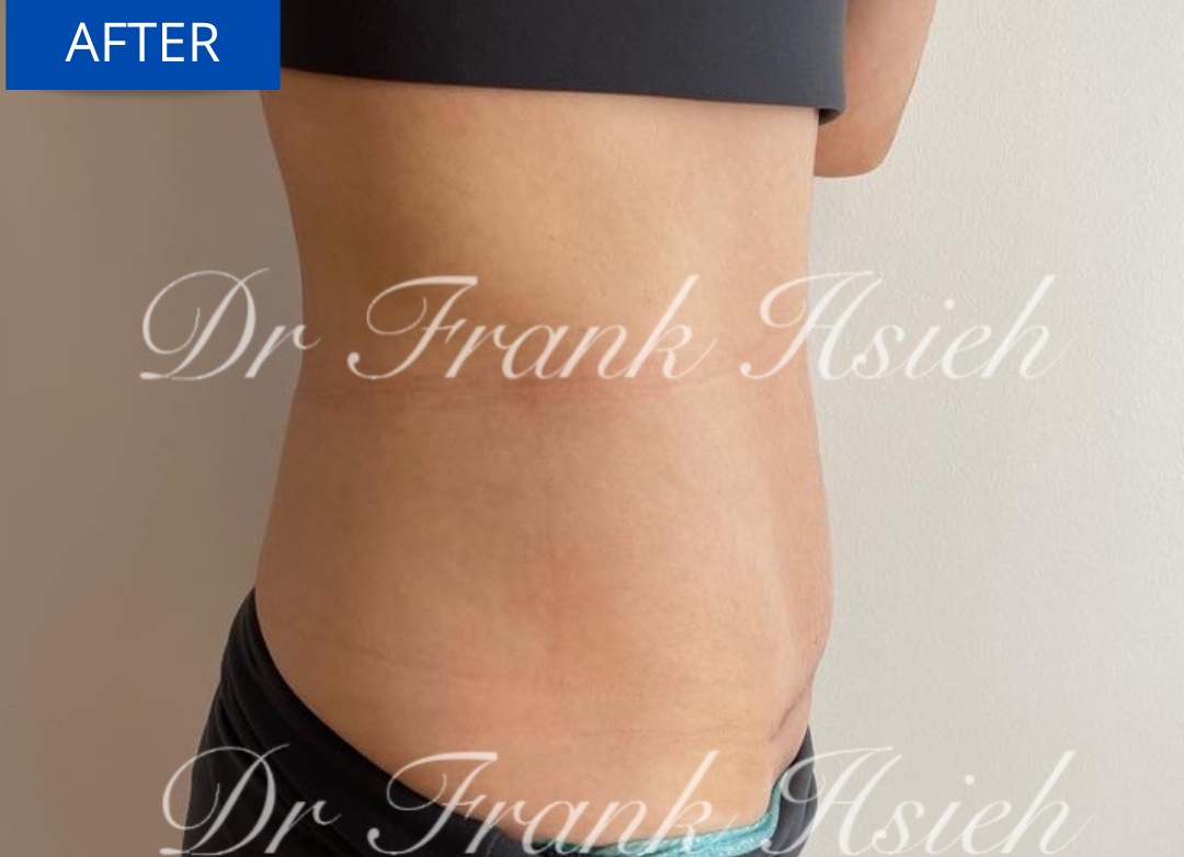 Mummy makeover tummy tuck