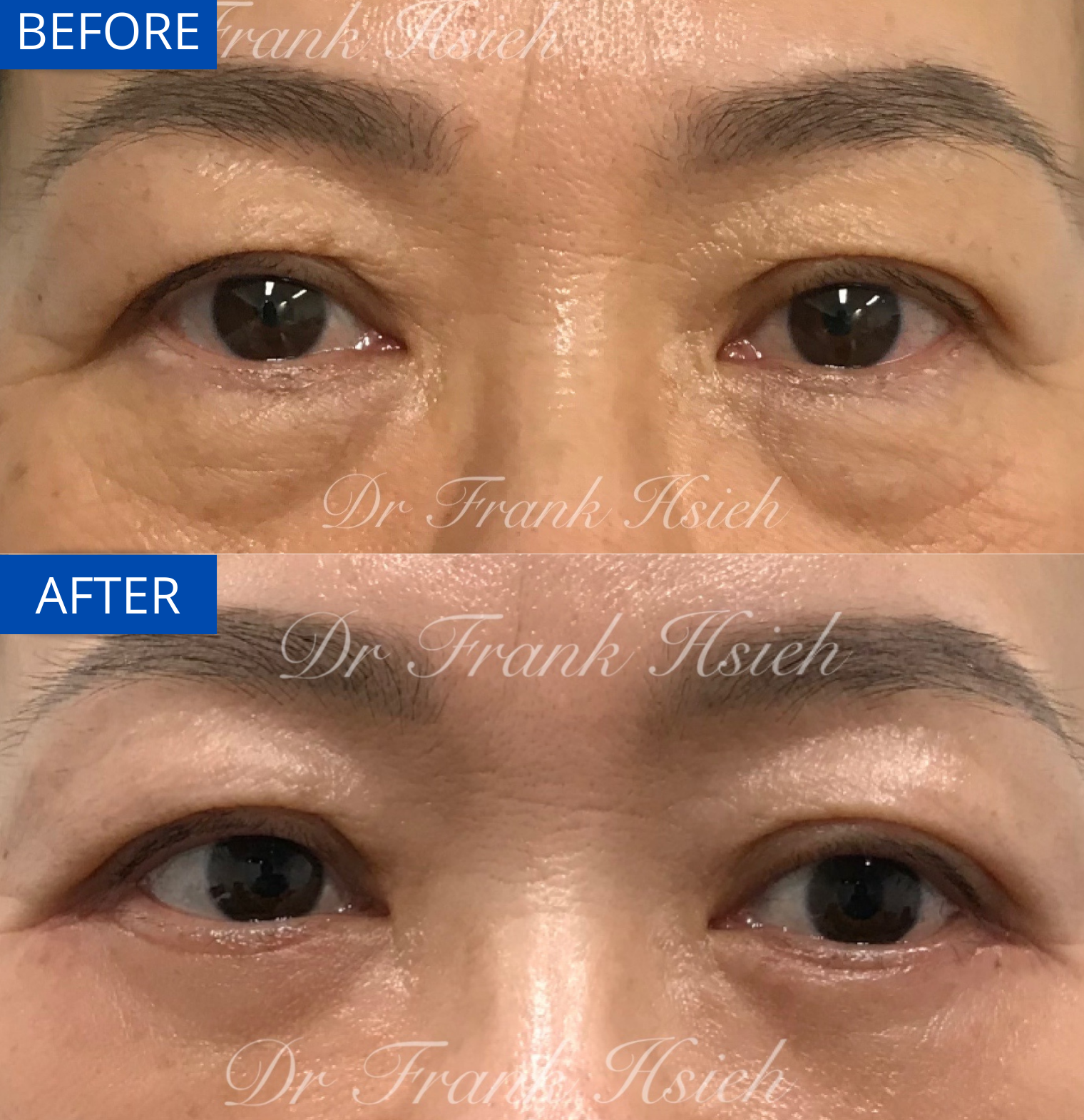 Eyebag removal Eyebagd removal