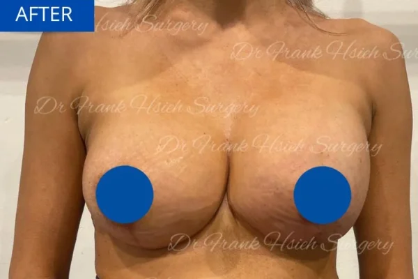 Breast Mastopexy/ Augmentation Case 4 After