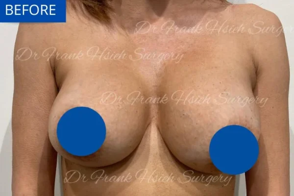 Breast Mastopexy/ Augmentation Case 4 Before