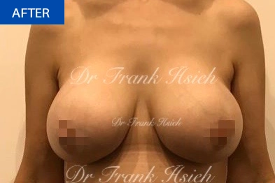 Breast Augmentation Case 1 After