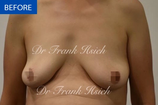 Breast Augmentation Case 1 Before