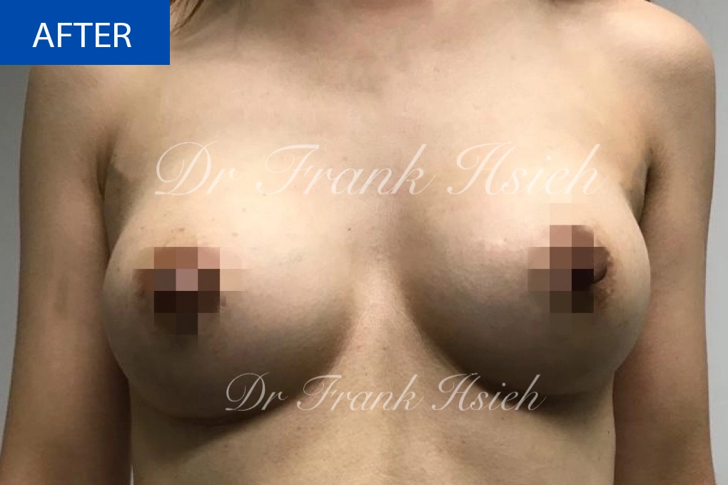 Breast Augmentation Case 2 After
