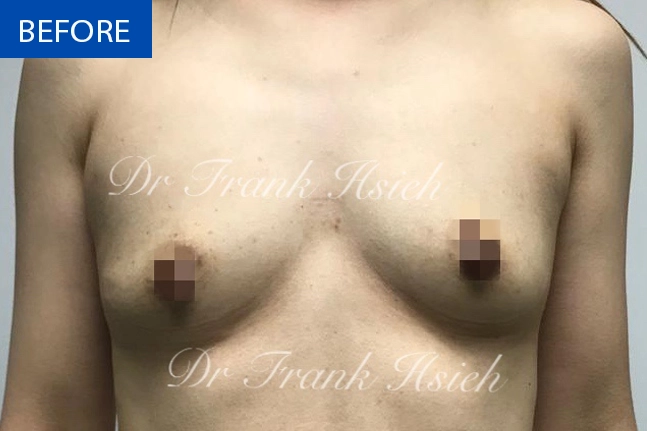 Breast Augmentation Case 2 Before