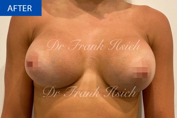 Breast Augmentation Case 3 After