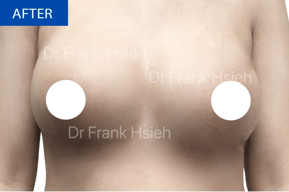 Breast Augmentation Case 4 After