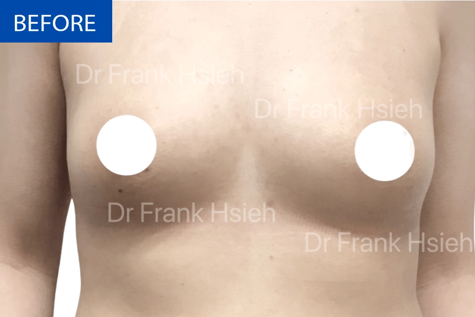 Breast Augmentation Case 4 Before