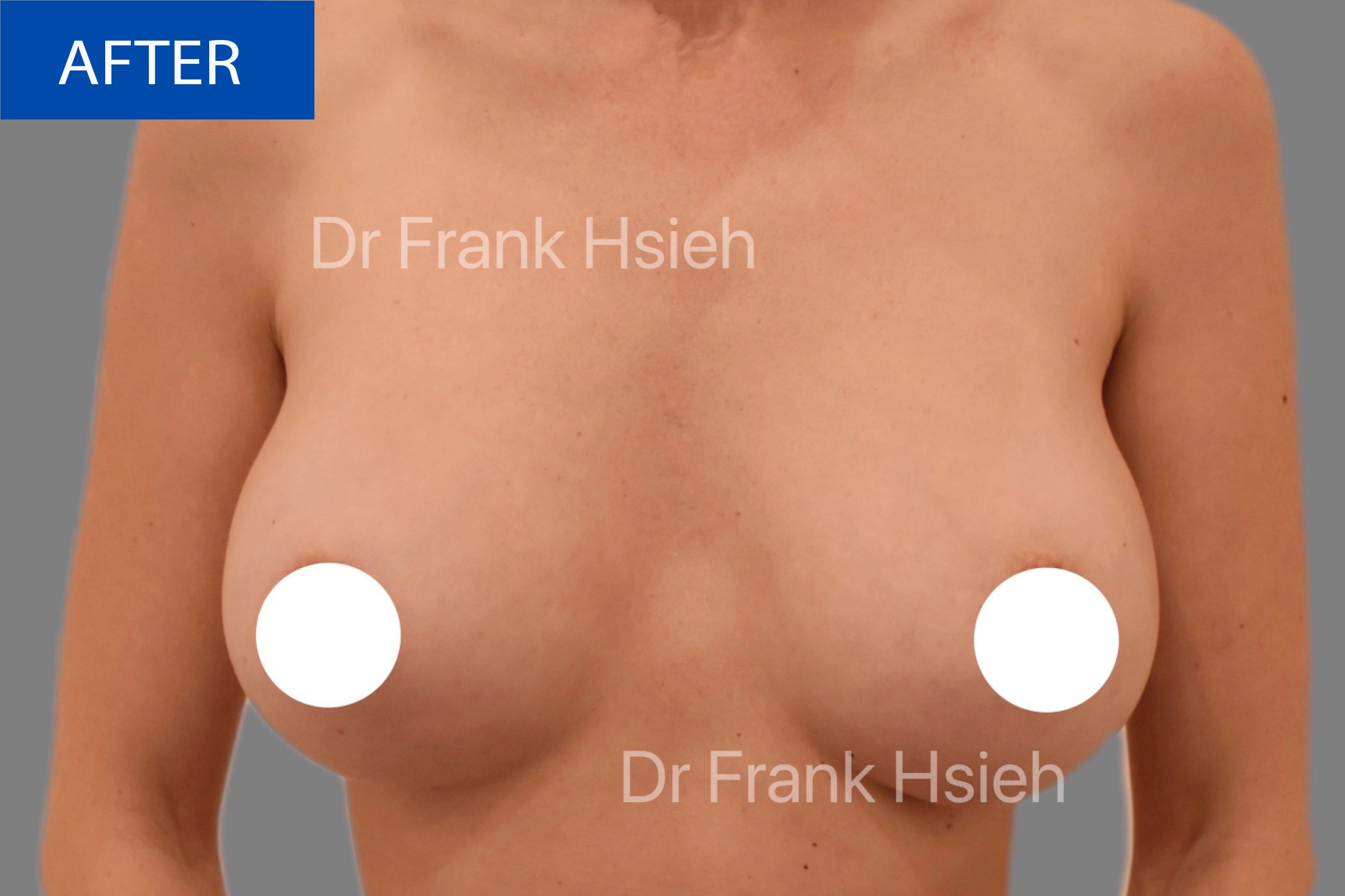 Breast Augmentation Case 5 After