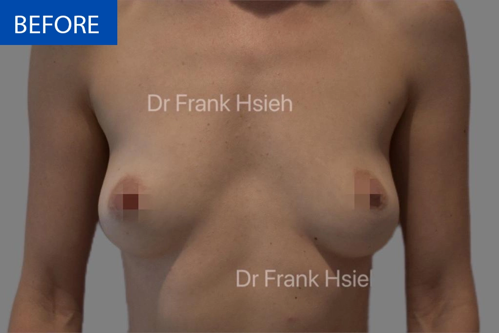 Breast Augmentation Case 5 Before