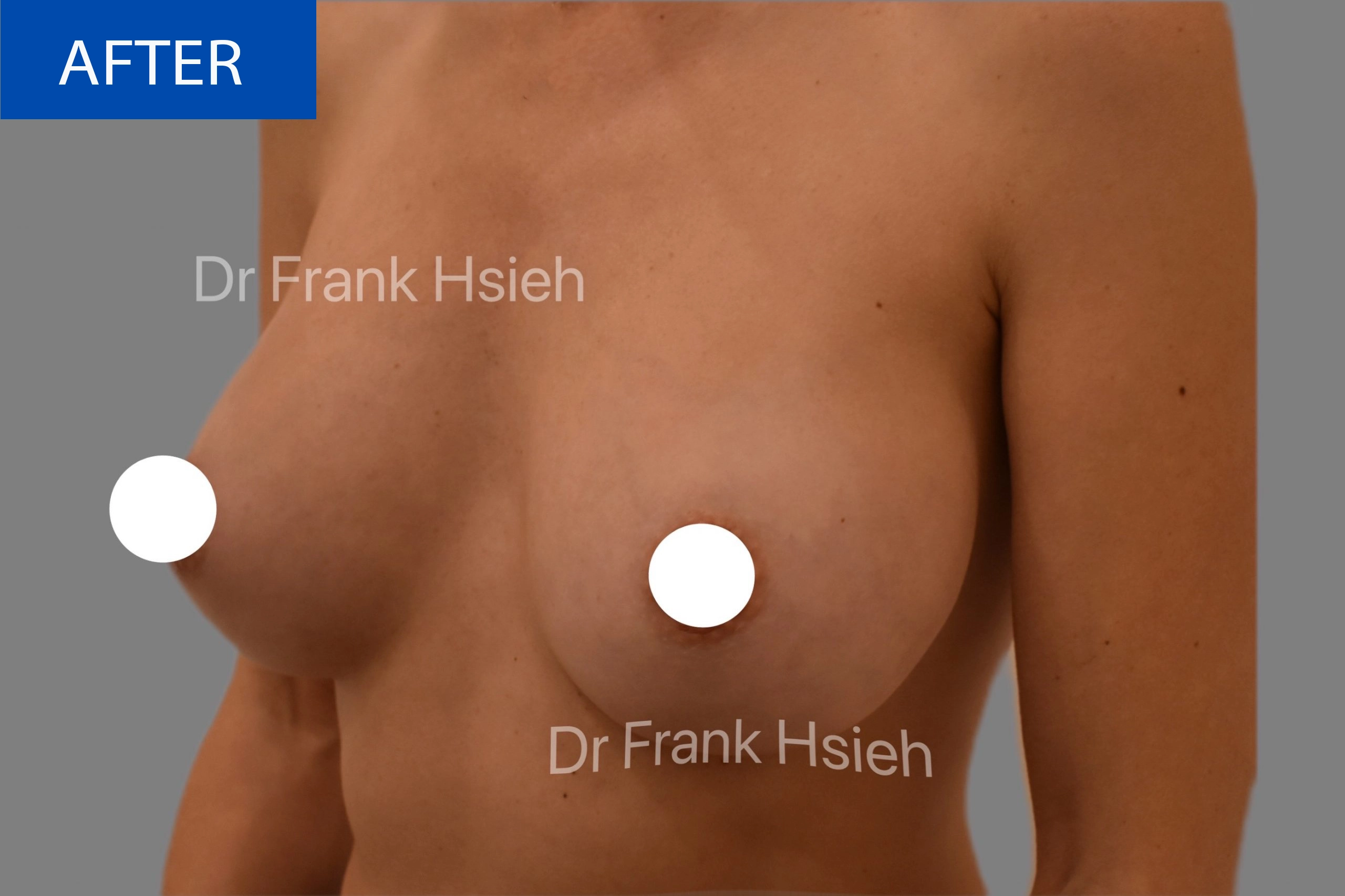 Breast Augmentation Case 6 L) Side After