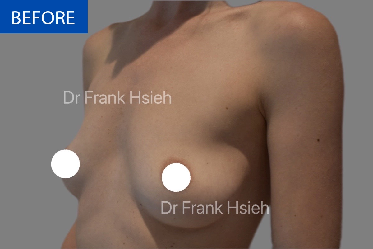 Breast Augmentation Case 6 L) Side Before
