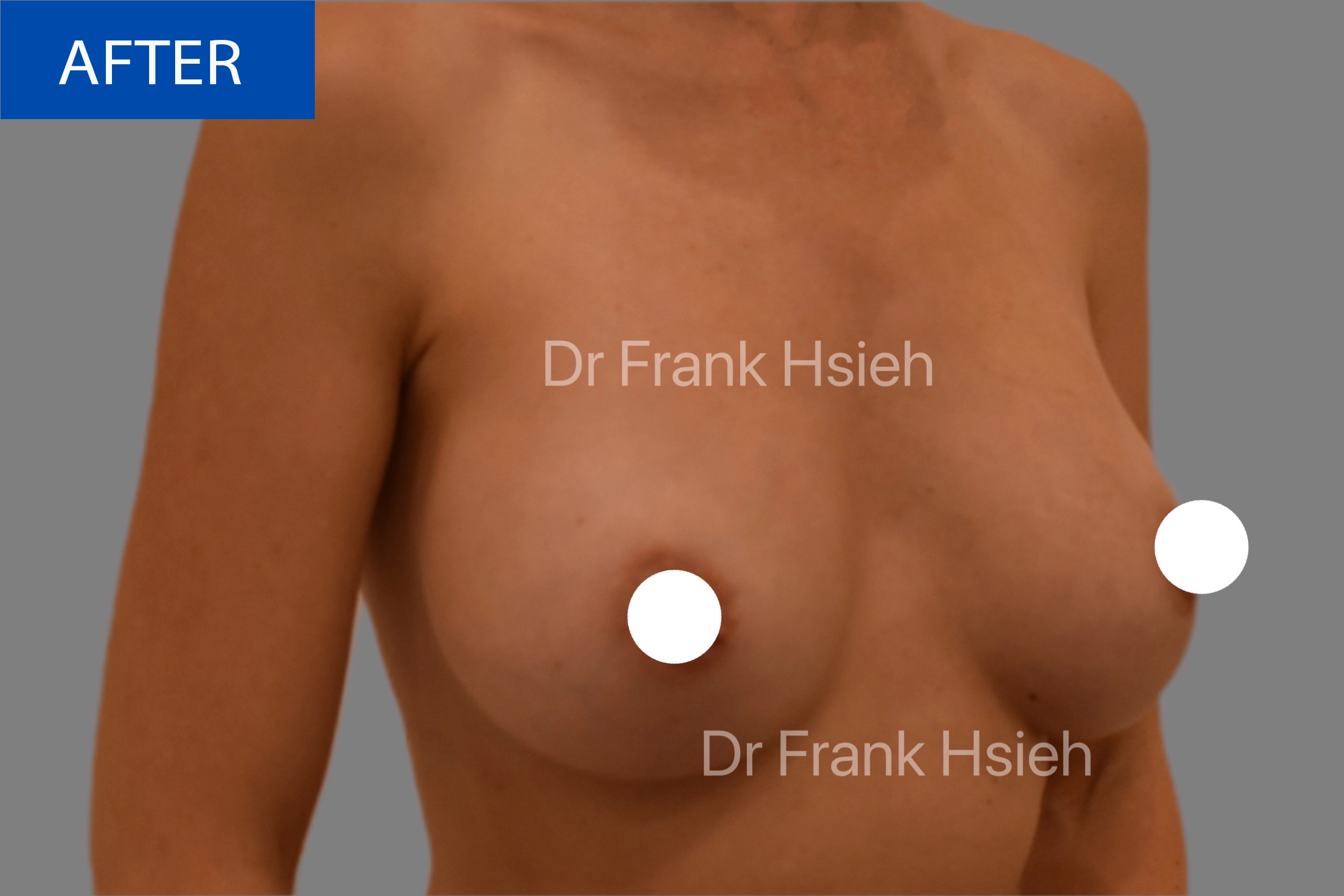 Breast Augmentation Case 6 R) Side After