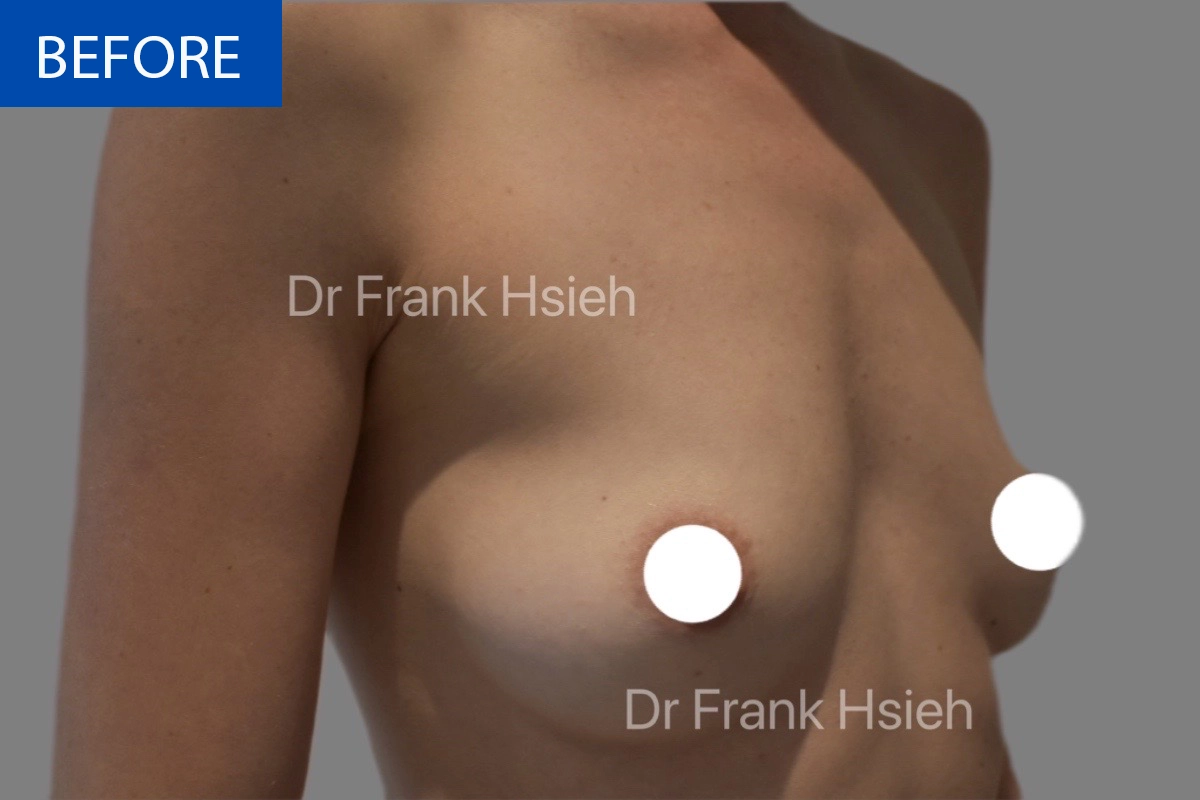 Breast Augmentation Case 6 R) Side Before
