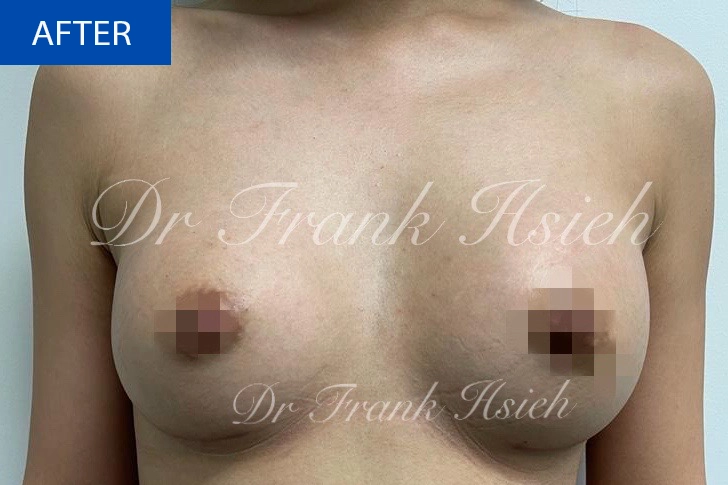 Breast Augmentation Case 7 After