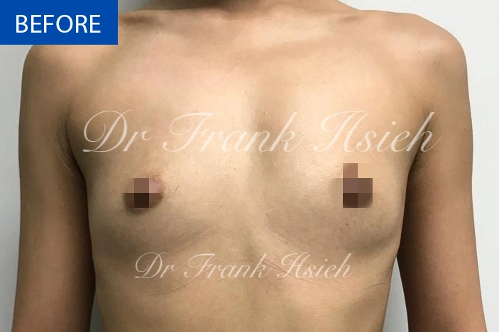 Breast Augmentation Case 7 Before