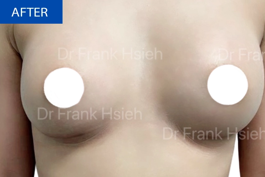 Breast Augmentation Case 8 After
