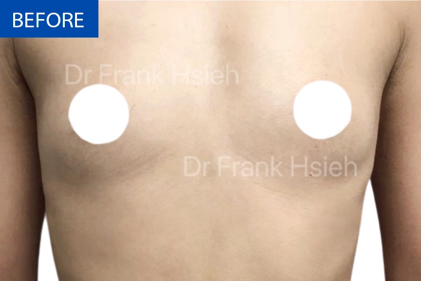 Breast Augmentation Case 8 Before