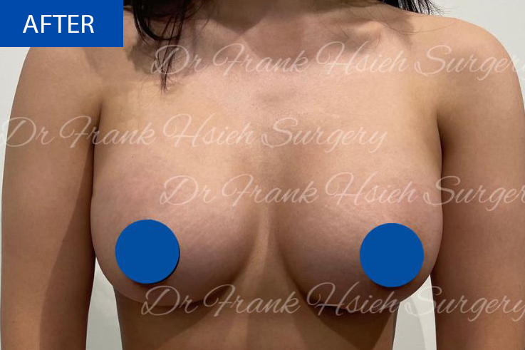 Breast Augmentation Case 9 After