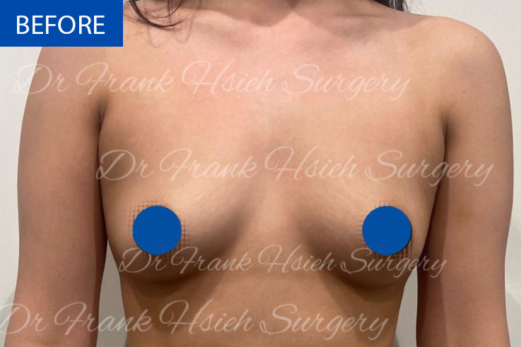 Breast Augmentation Case 9 Before