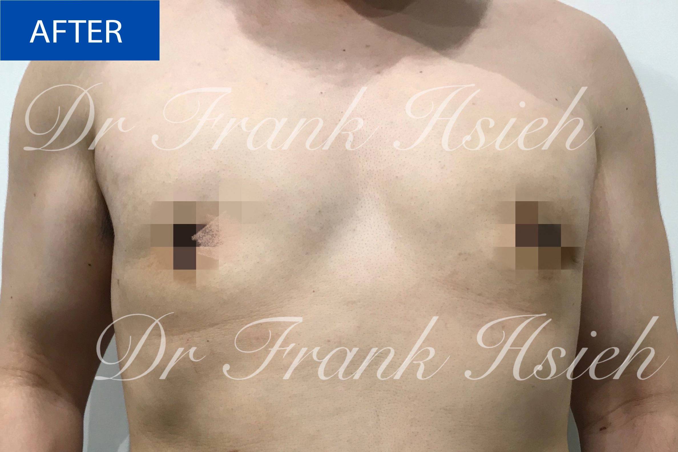 Breast Gynaecomastia Case 1 After