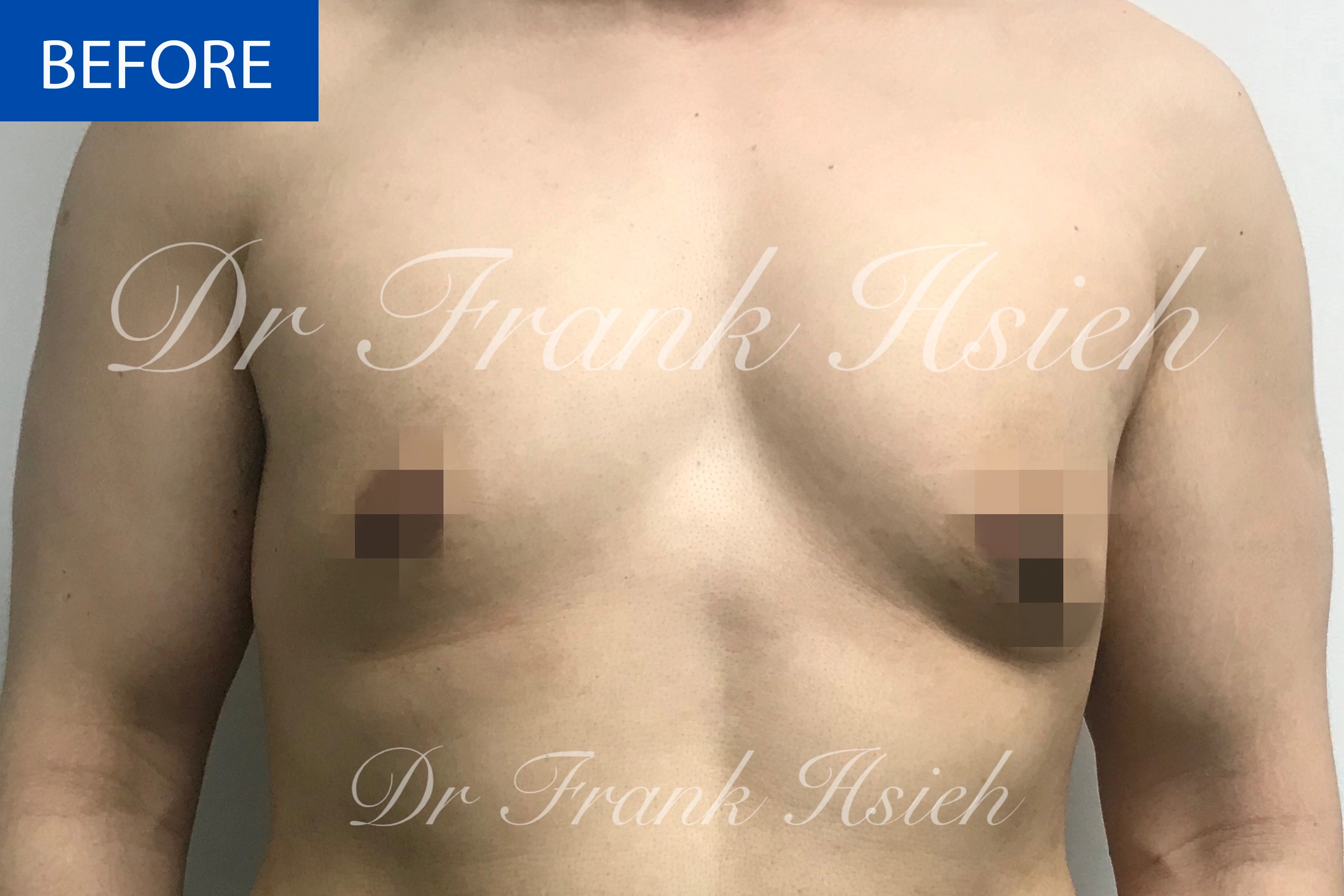 Breast Gynaecomastia Case 1 Before