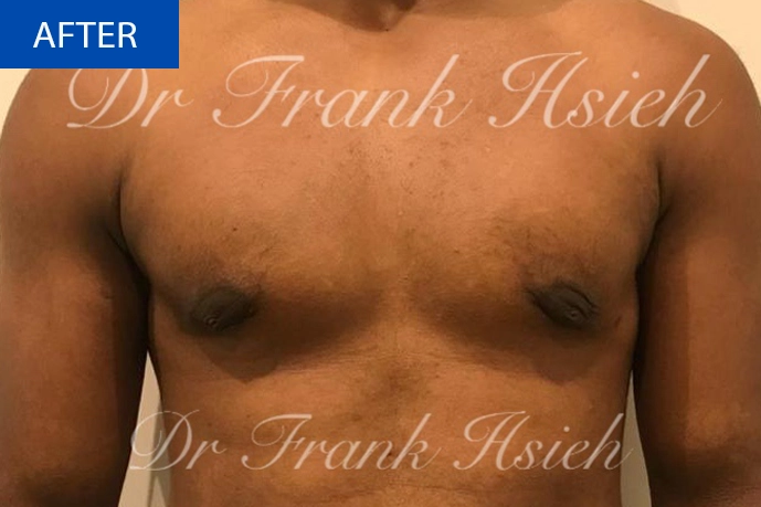 Breast Gynaecomastia Case 2 After