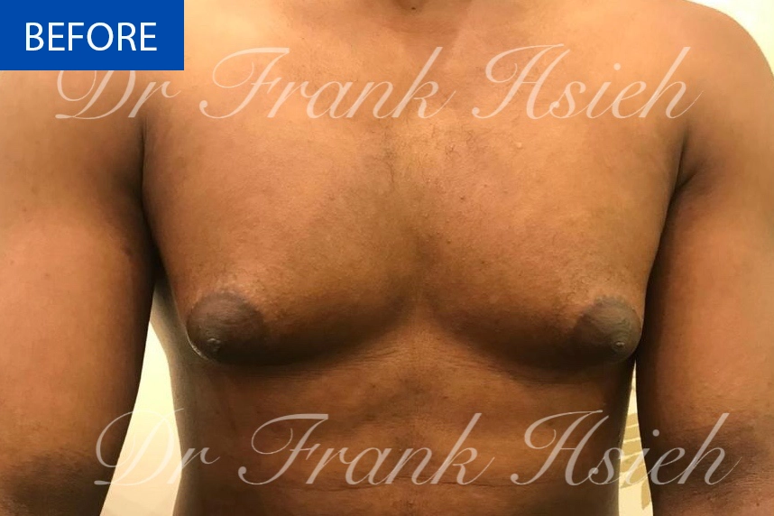Breast Gynaecomastia Case 2 Before