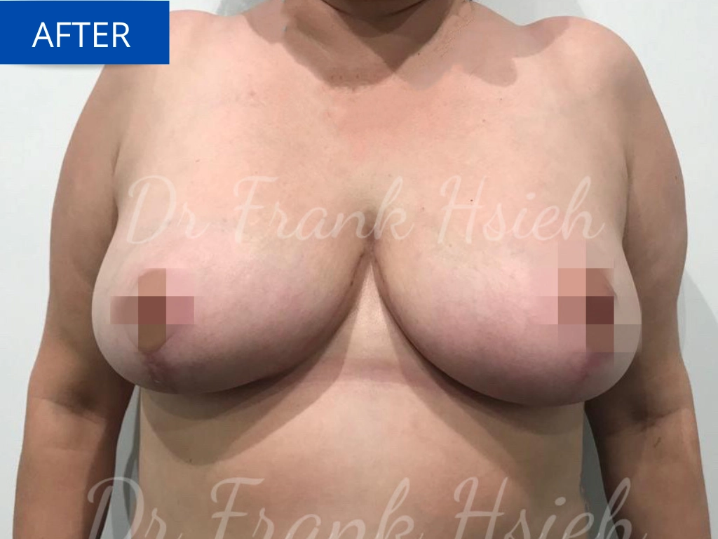 Breast Reduction Case 1 After