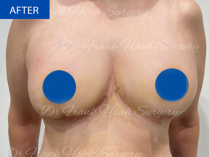 Breast Reduction Case 10 After
