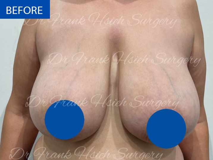 Breast Reduction Case 10 Before