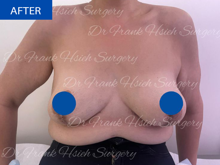 Breast Reduction Case 11 After
