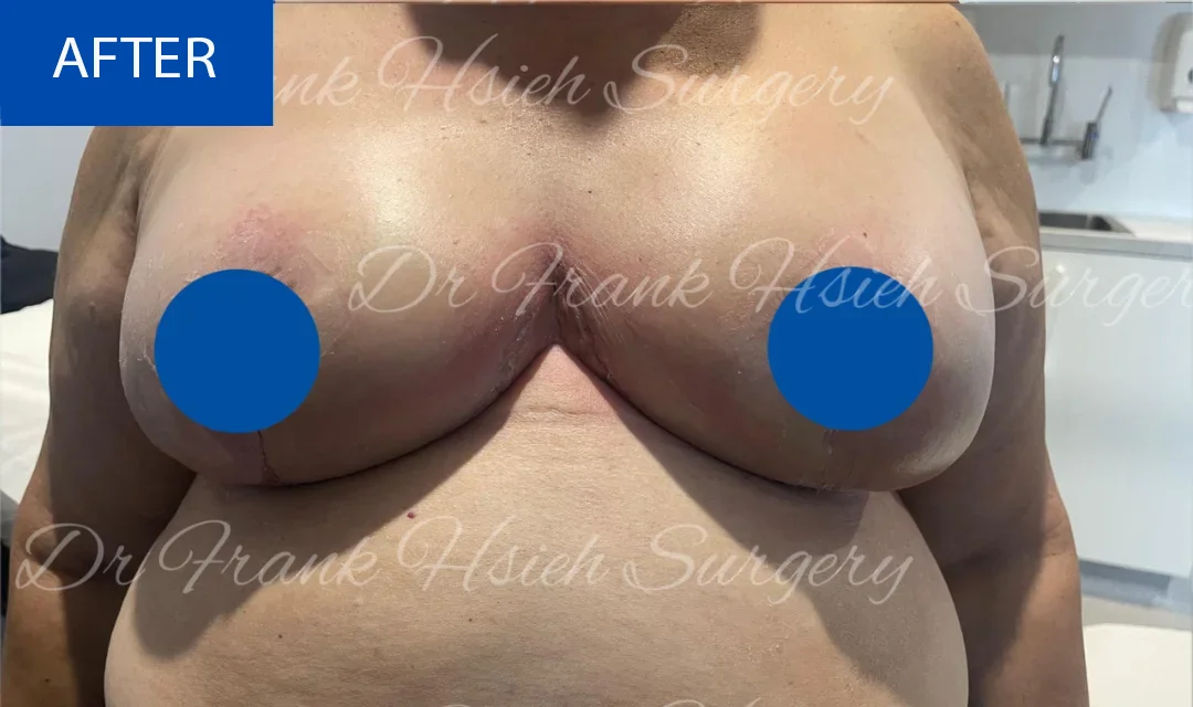 Breast Reduction Case 12 After