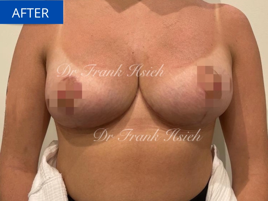 Breast Reduction Case 3 After