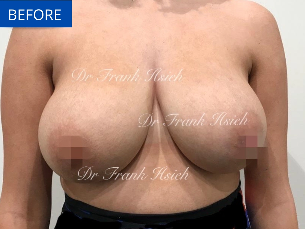 Breast Reduction Case 3 Before