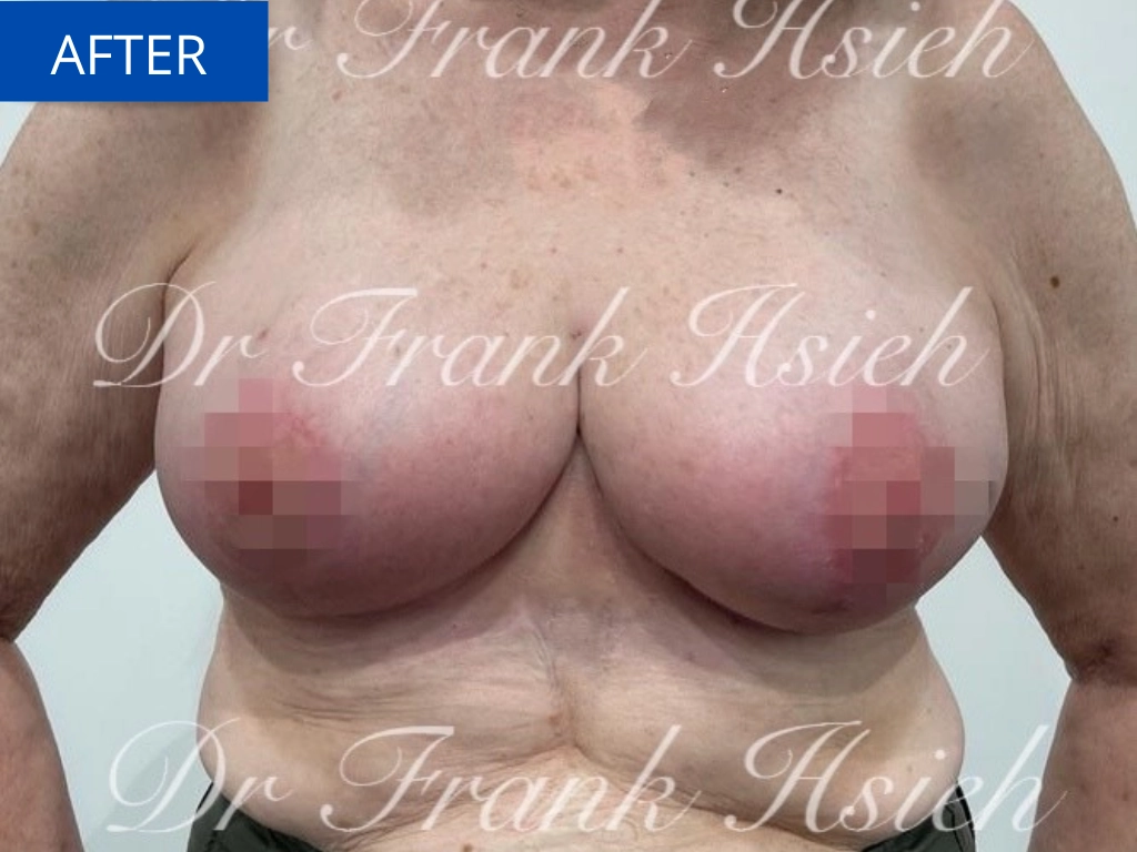 Breast Reduction Case 4 After