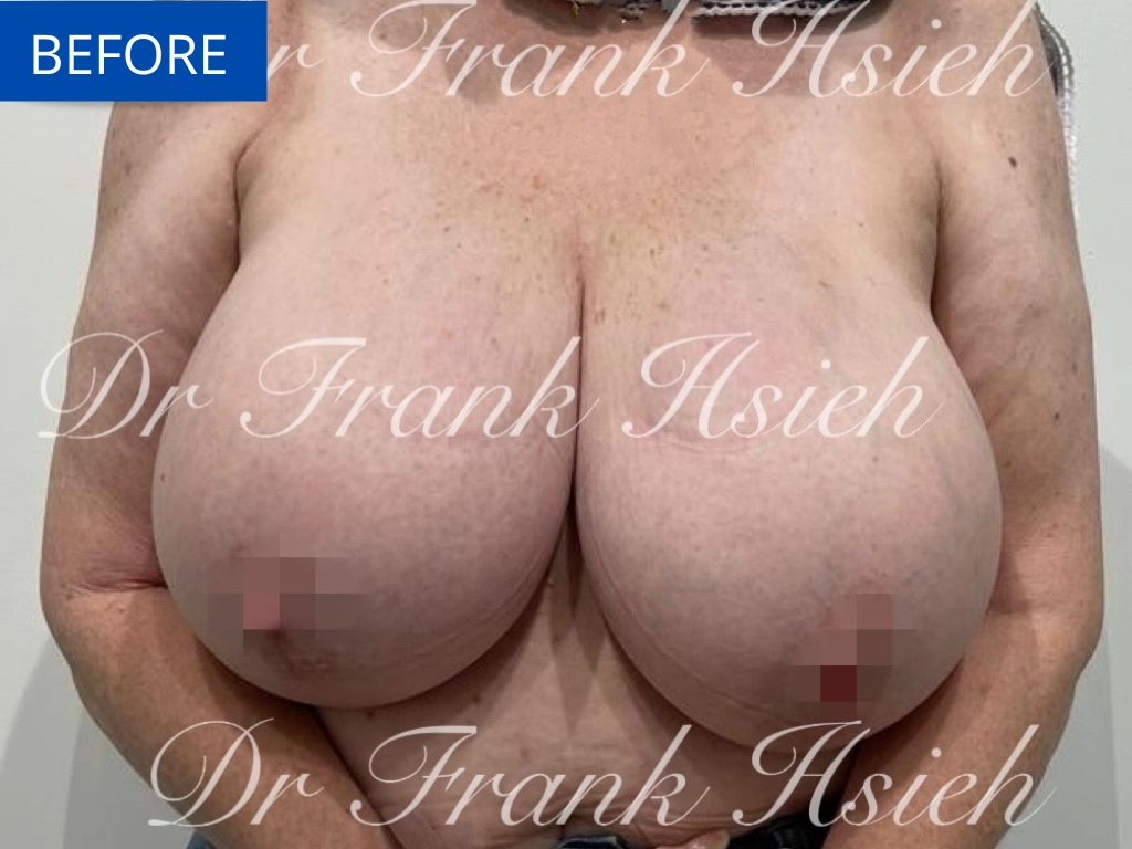 Breast Reduction Case 4 Before