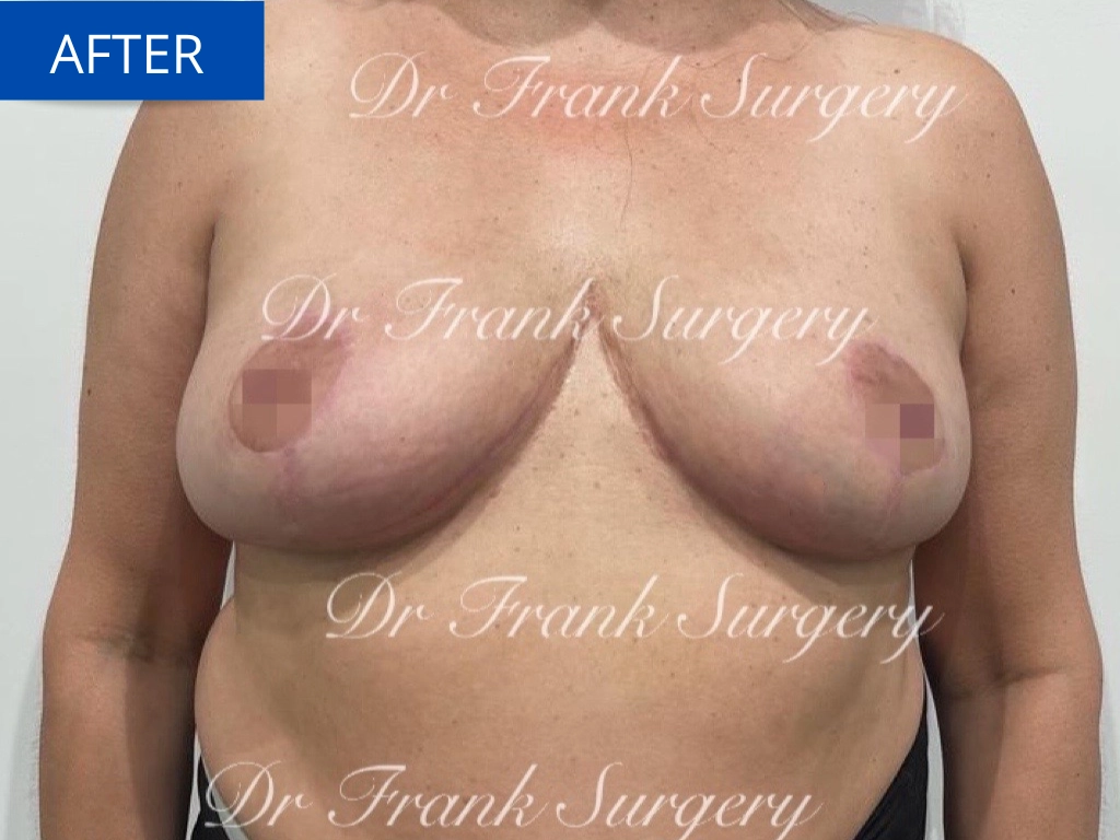 Breast Reduction Case 5 After