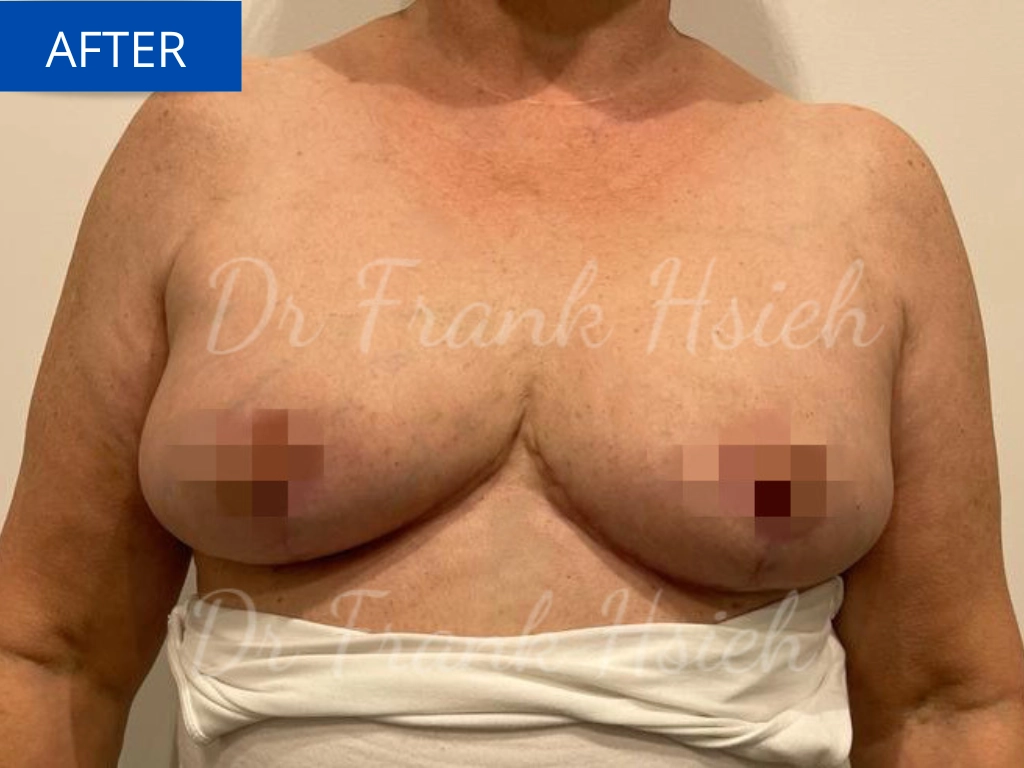 Breast Reduction Case 6 After