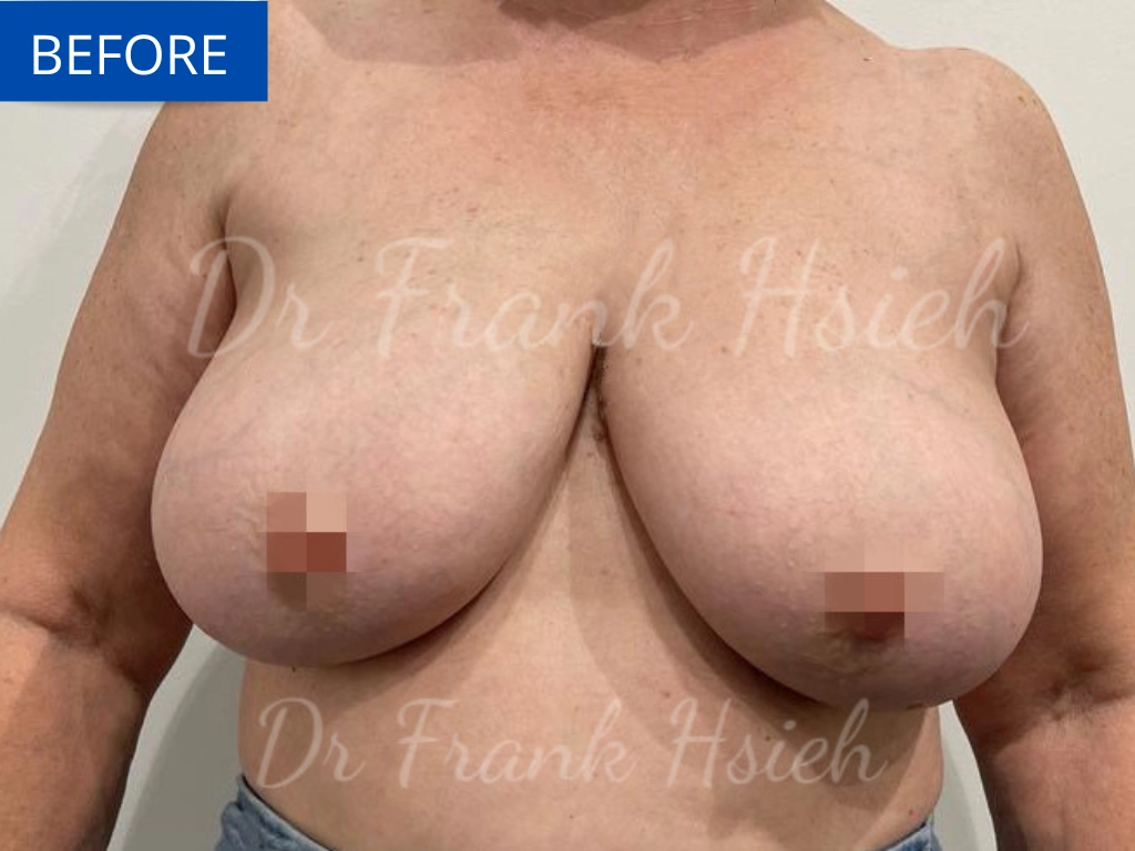Breast Reduction Case 6 Before