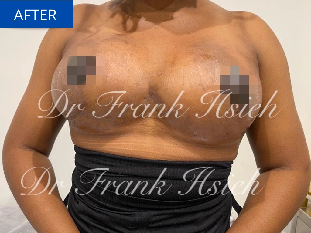 Breast Reduction Case 7 After