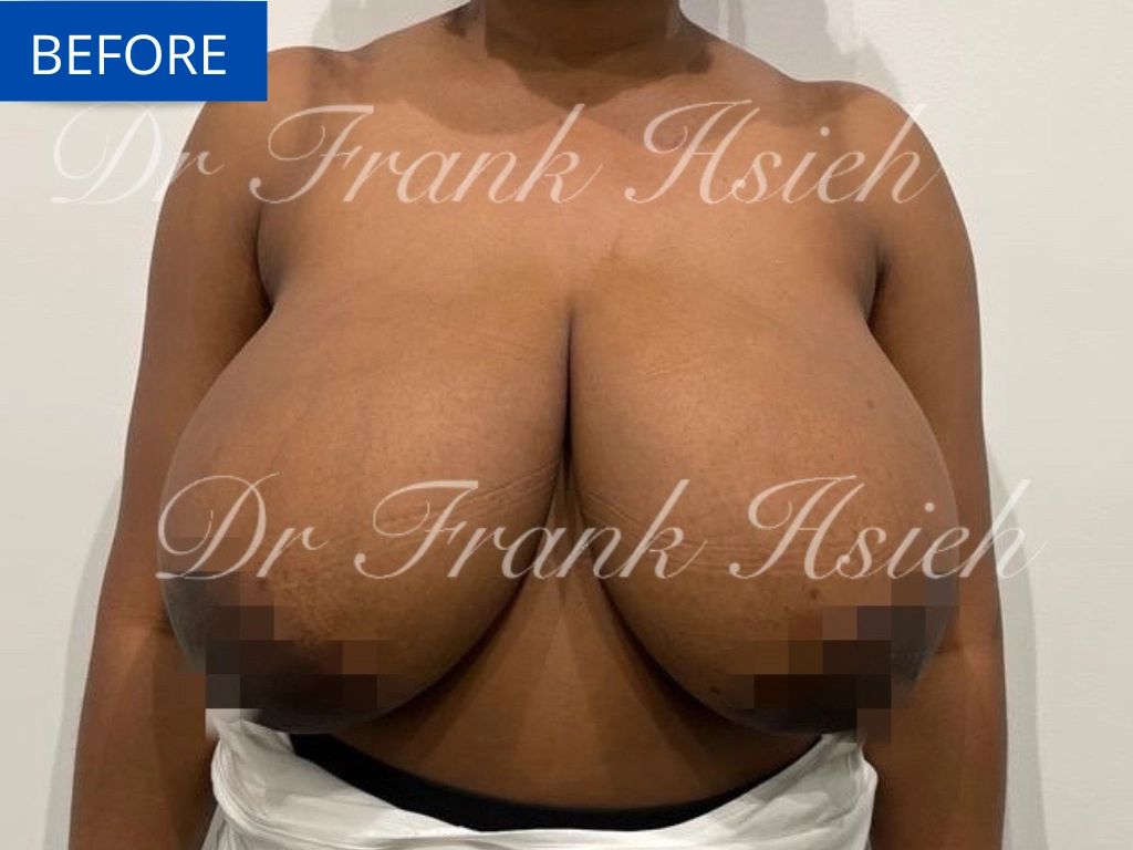 Breast Reduction Case 7 Before