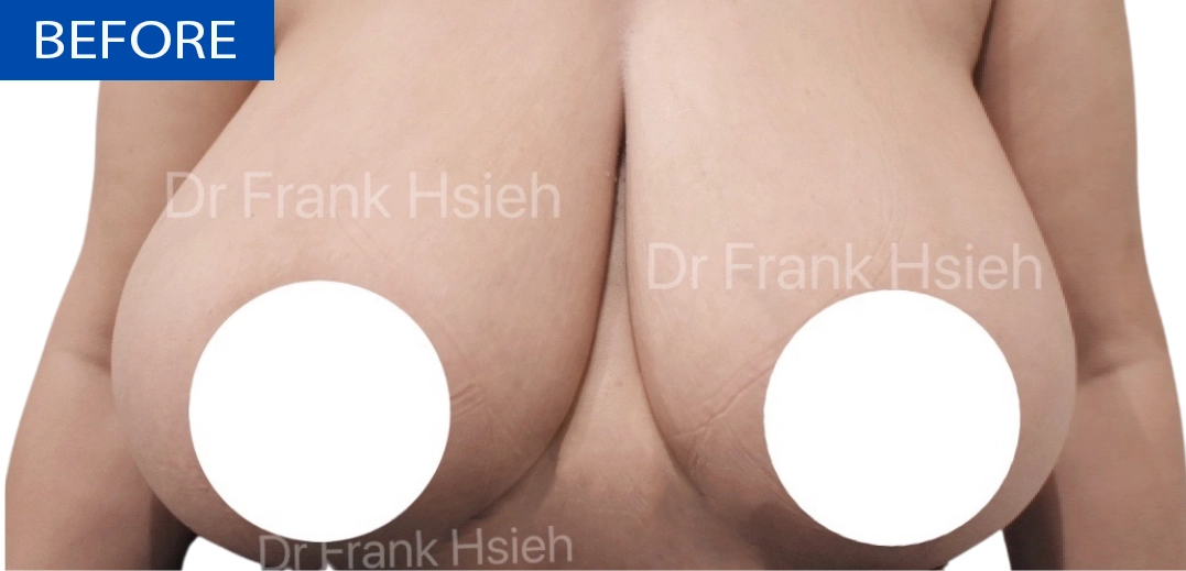 Breast Reduction Case 8 Before