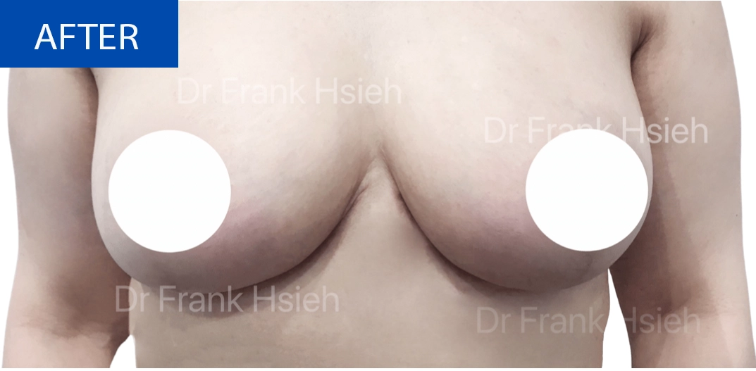 Breast Reduction Case 9 After
