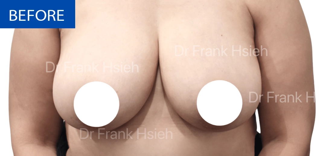 Breast Reduction Case 9 Before