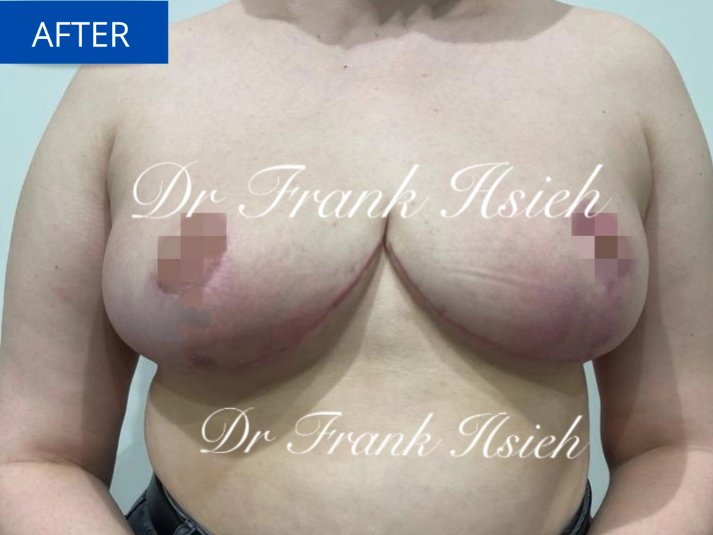 Breast Reduction Case 2 After