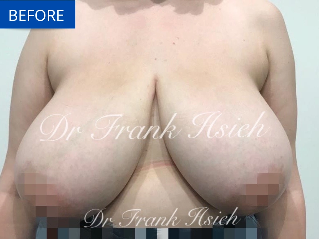 Breast Reduction Case 2 Before